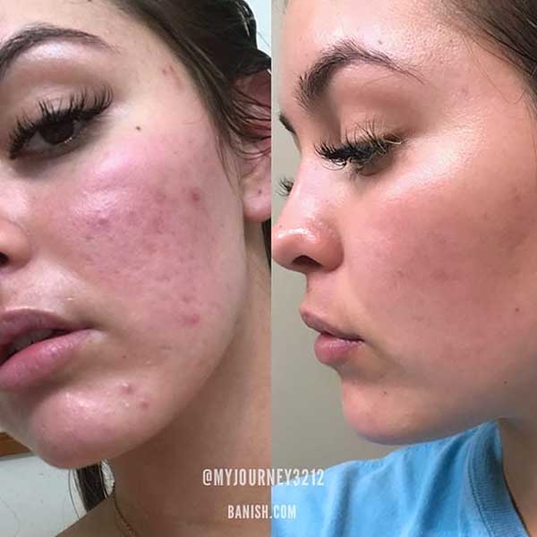 acne scars before and after banish starter kit