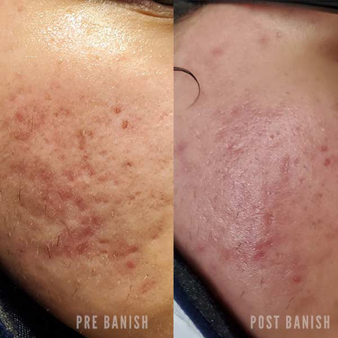 banish before and after on pitted scars