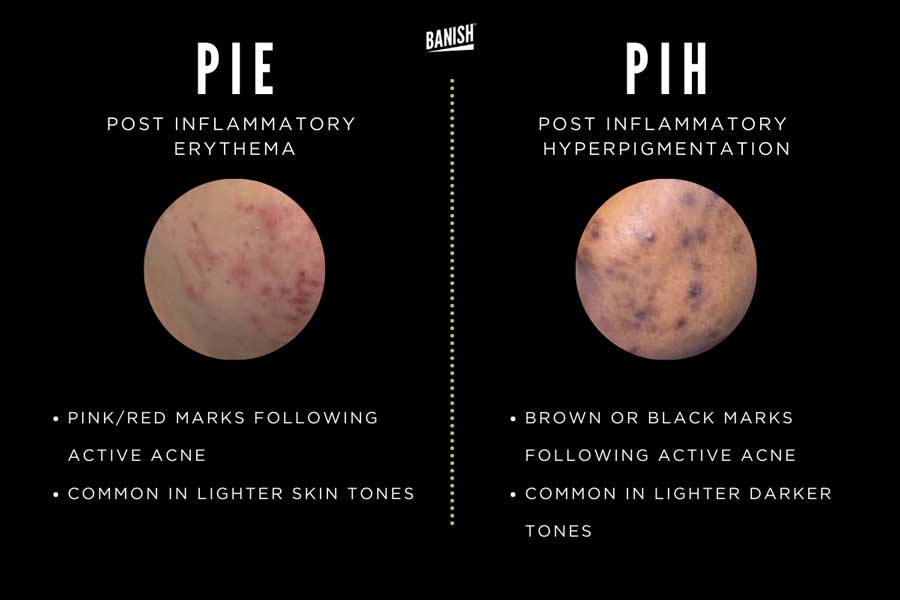 Difference Between PIH and PIE