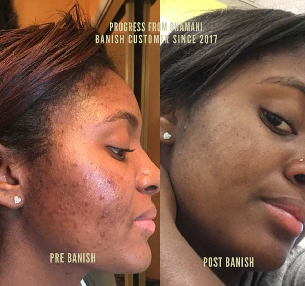 banish acne scars results on pigmented skin
