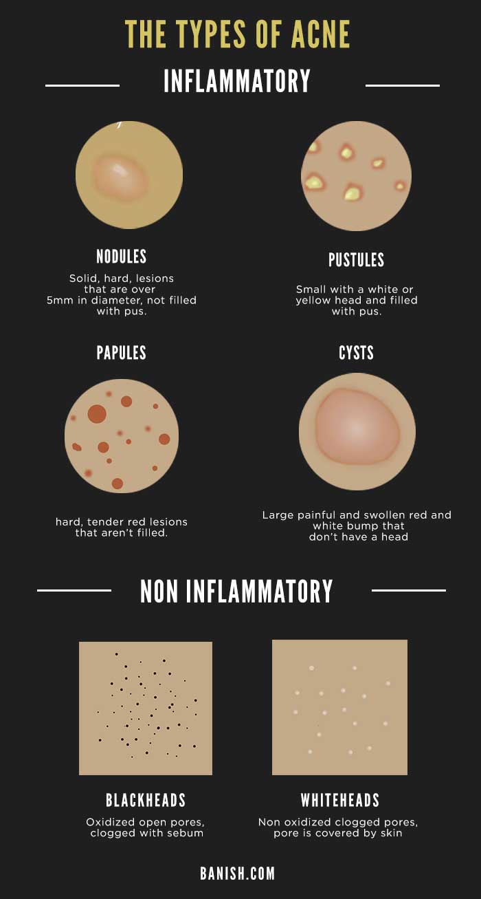 the types of acne infographic