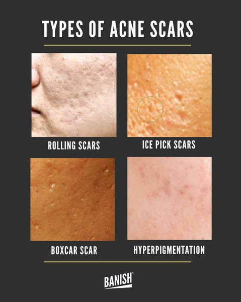 types of acne scars infographic