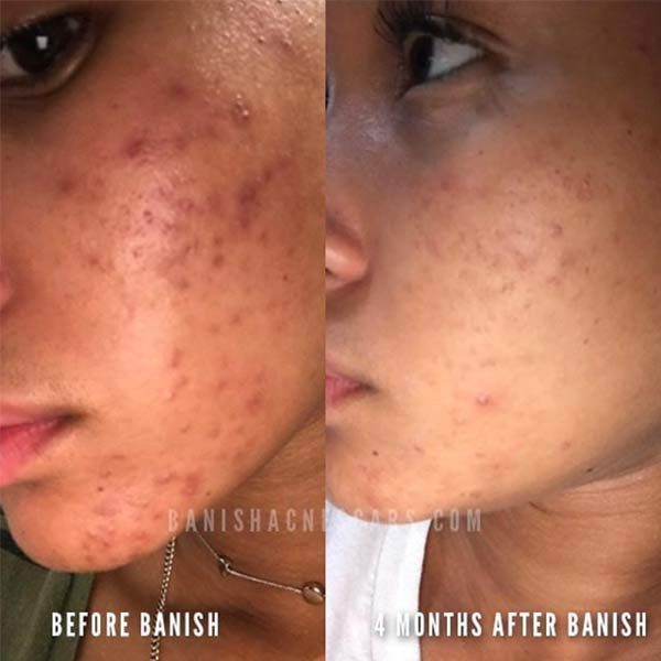 acne scars before after on dark skin