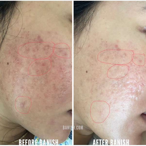 acne scar progress photo 1 month