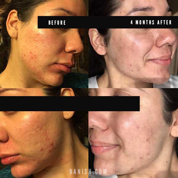 before after acne progress photo with Banish