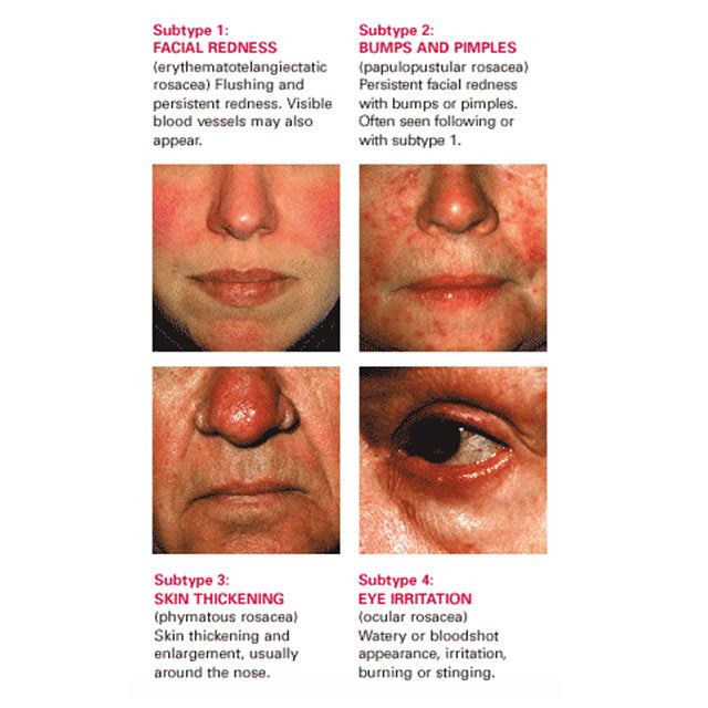 Acne caused by rosacea