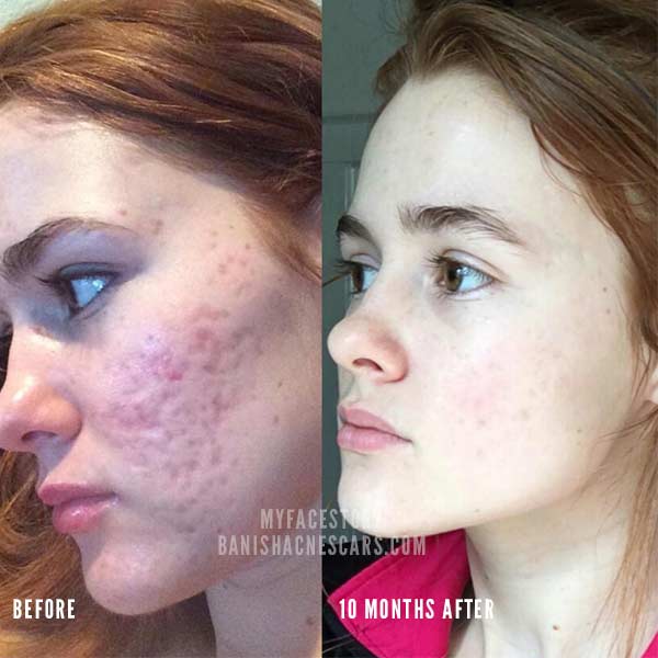 acne scars before and after myfacestory