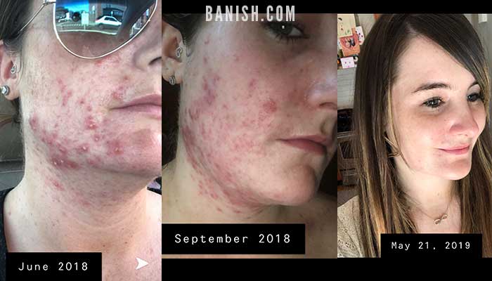 kelsie before after banish acne scars