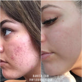 Before and after using microneedling