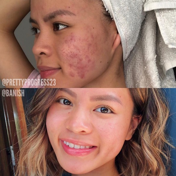 How To Get Rid Of Acne Scars Fast - What Actually - BANISH
