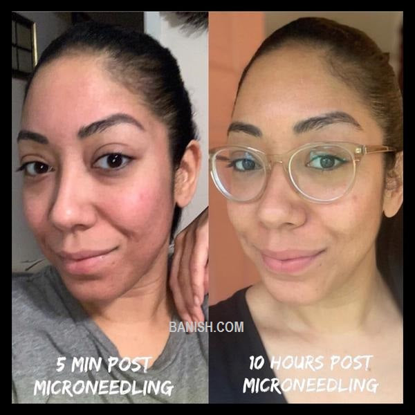 woman showing her before and after results with microneedling