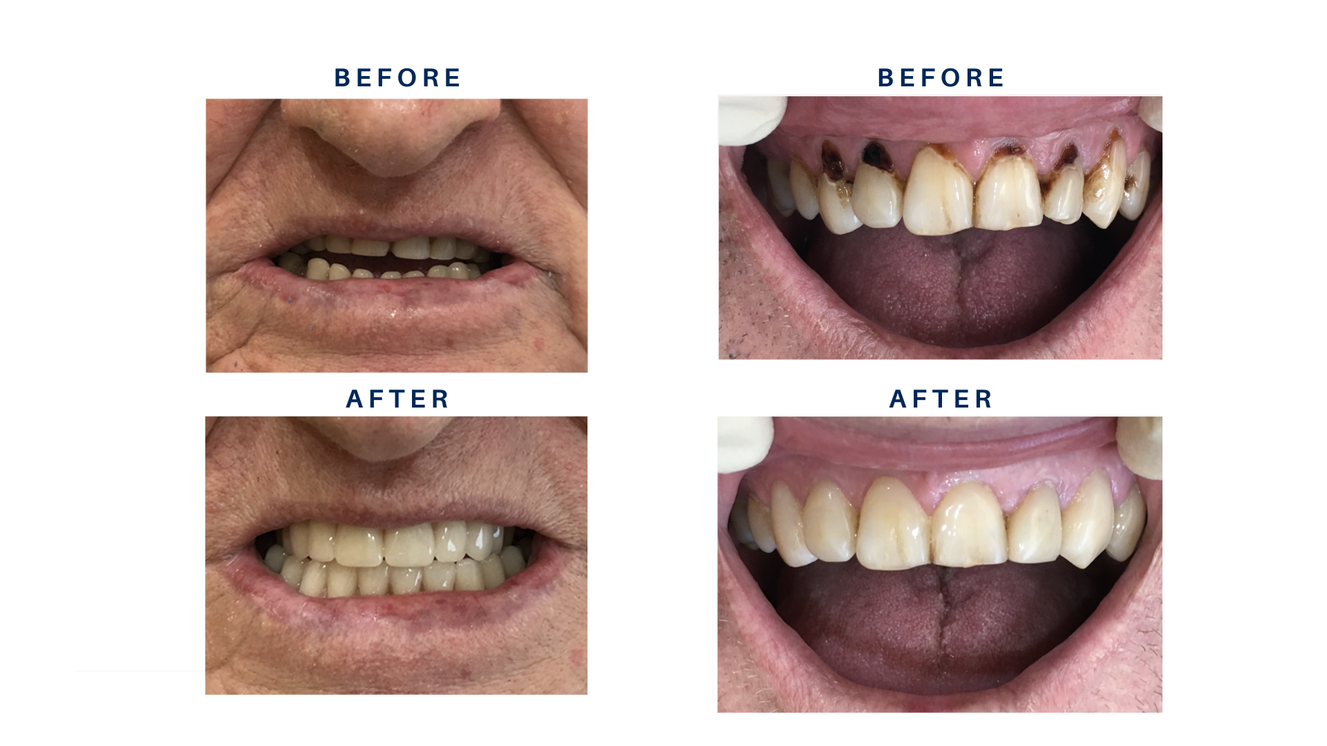 Before and After Pictures dental work done by Dr Mahi