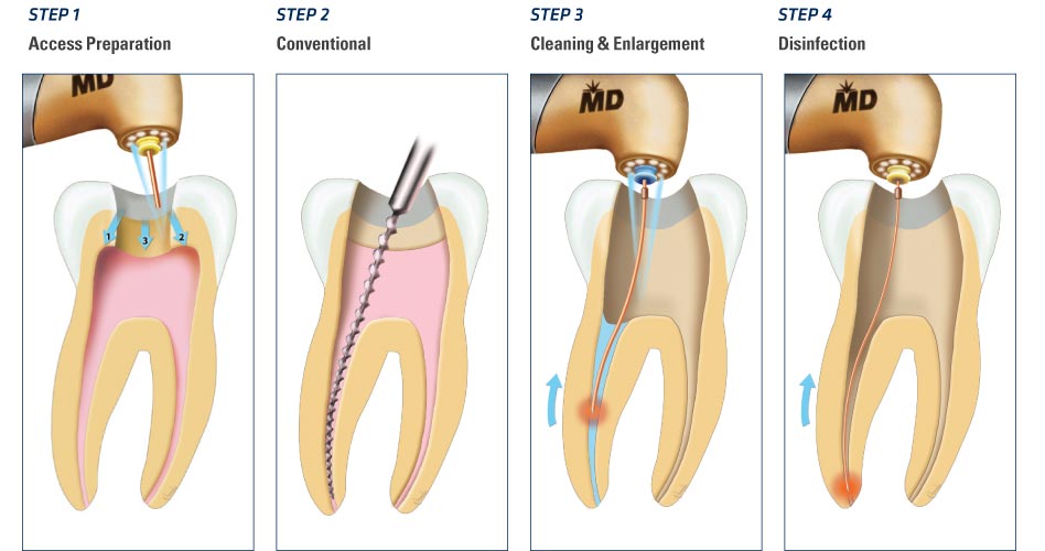 root canal treatment