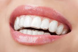 invisalign invisible braces