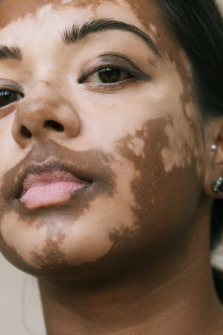 vitiligo beauty captured