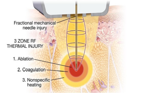 Morpheus8 subdermal adipose fractional remodeling device