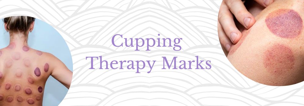 Cupping Therapy Marks