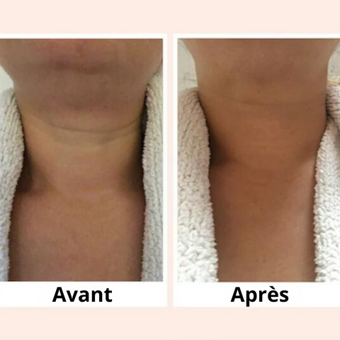 L'image montre le cou d'une femme âgée avant et après l'utilisation du l'appareil masseur