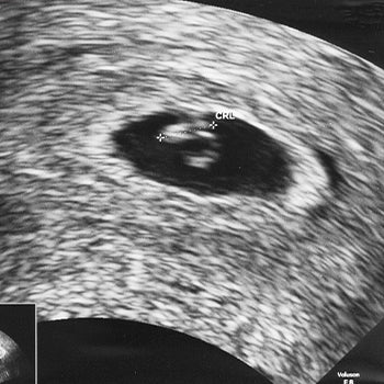 two month pregnancy ultrasound