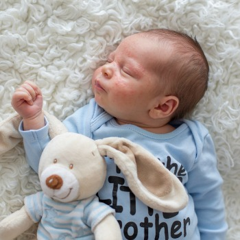 sleeping baby with baby acne