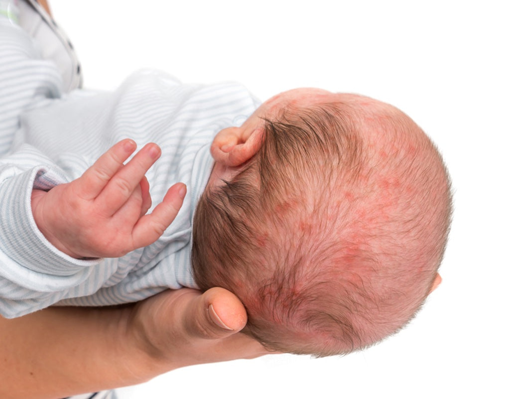 baby eczema vs. acne