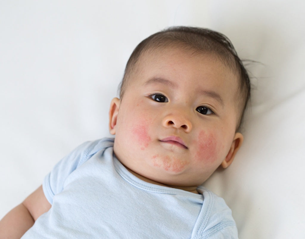 baby eczema vs. acne