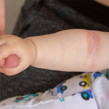 4 summer skin conditions your baby may experience (and how to deal with  them)