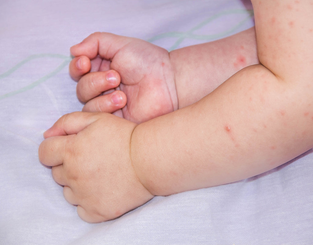 baby's arms with contact dermatitis