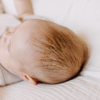 Baby with cradle cap