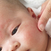 eczema prone baby skin