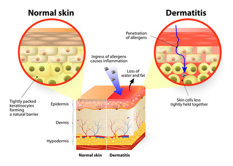 diagram of normal and dermatitis skin 