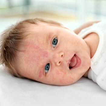 example of a baby eczema flare-up