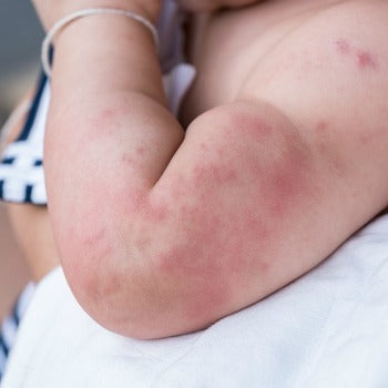 example of baby hives on skin of arm