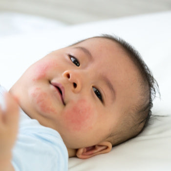 baby with rash on face from food allergies of breastfeeding diet