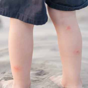 bug bites on baby legs