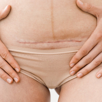 C-Section Scars: The Complete Care Guide