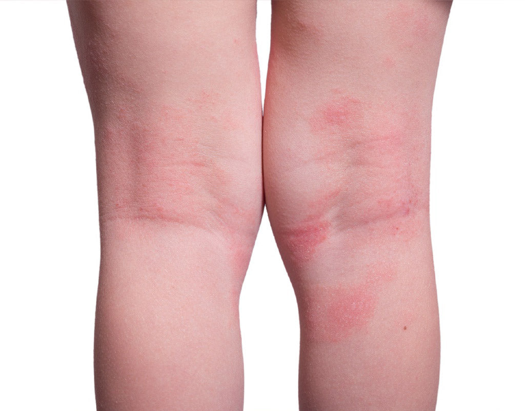 Woman with eczema on her legs