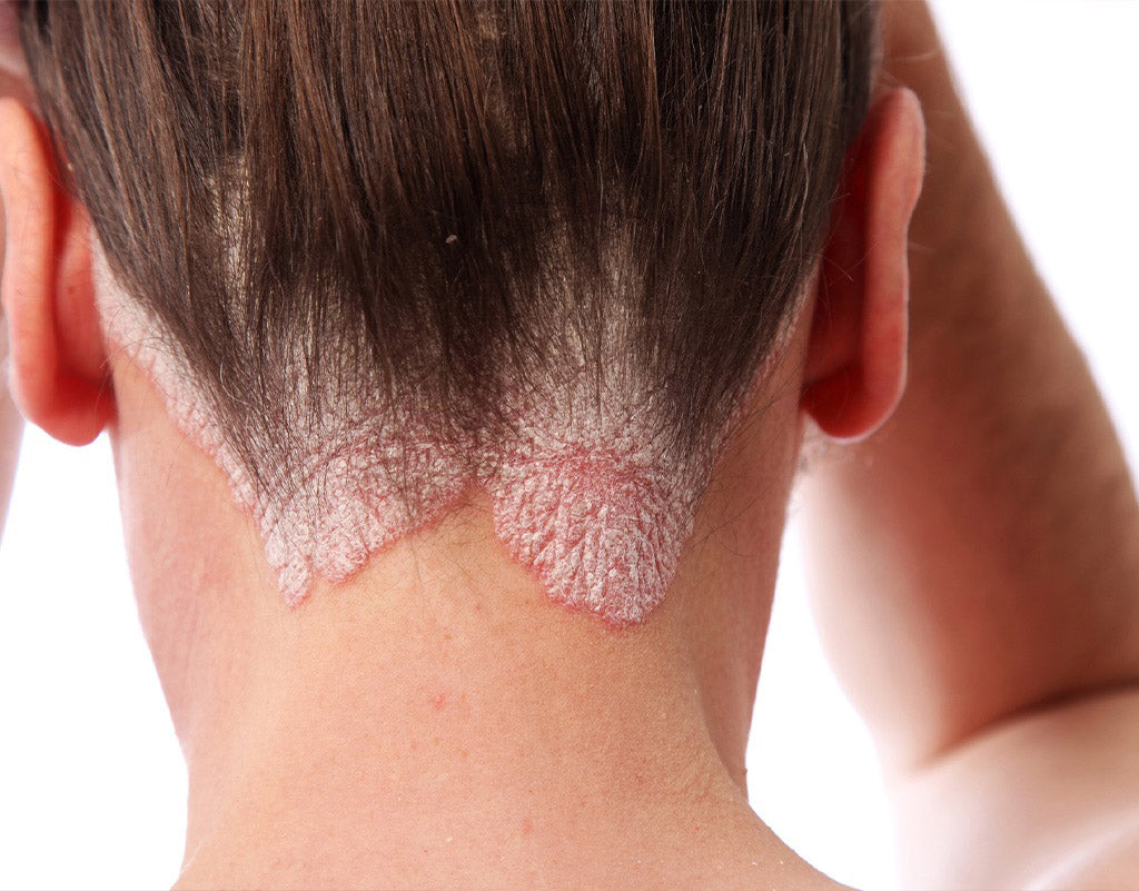 Woman with psoriasis on her hair line