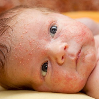 Baby with acne