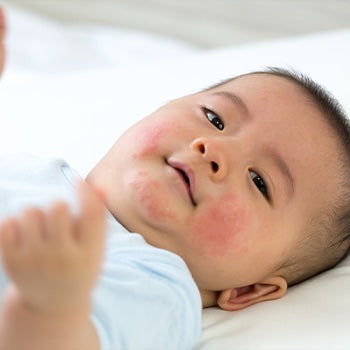 Cheeks In A Baby: Causes, Treatment, And