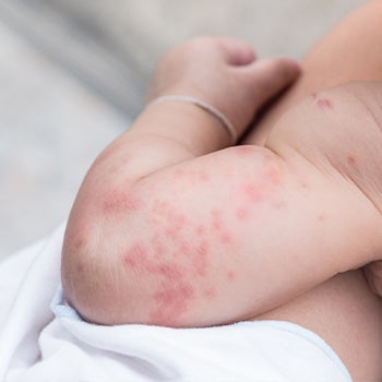 baby with eczema on the arm