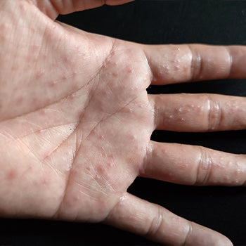 different types of eczema on the hands