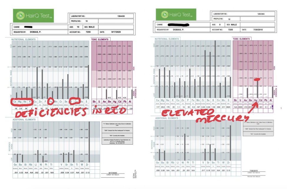 Example of HairQ Test results one showing deficiencies and the other showing elevated mercury levels