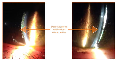 Deposits on the a scleral contact lens leading to lens fogging