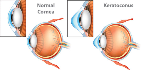 keratoconus diagram