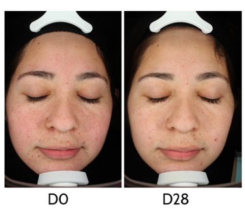 Before and after using Heliocare 360° A-R Emulsion for 28 days