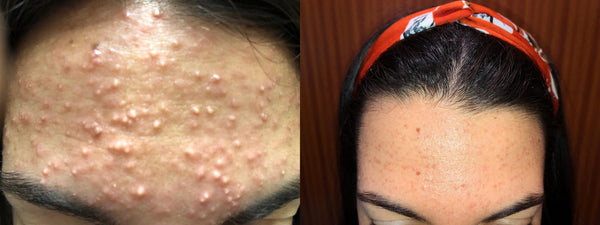 Before and after showing acne clearing after 60 days using Biretix Tri-Active Anti-Blemish Gel
