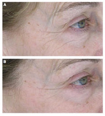 Sytenol A affect on wrinkles