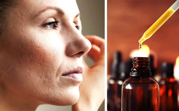 Frankincense Oil For Acne: A Natural Solution – Moksha Lifestyle