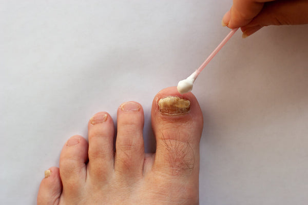 What To Do if You're Losing a Toenail to Fungus - Strut Blog